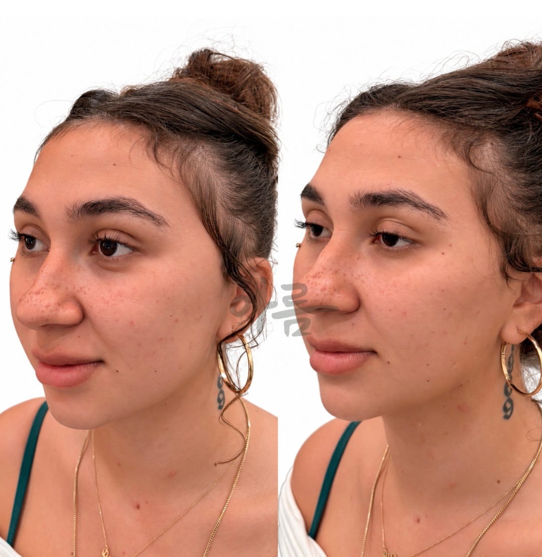 Before-and-after Evolysse filler comparison showing the face from an angled view