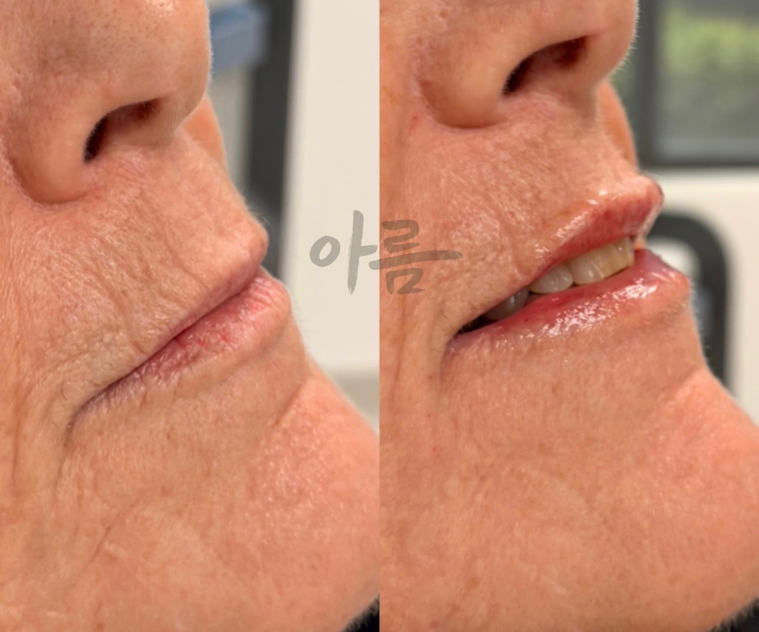 Before-and-after Evolysse filler comparison showing the lips in profile