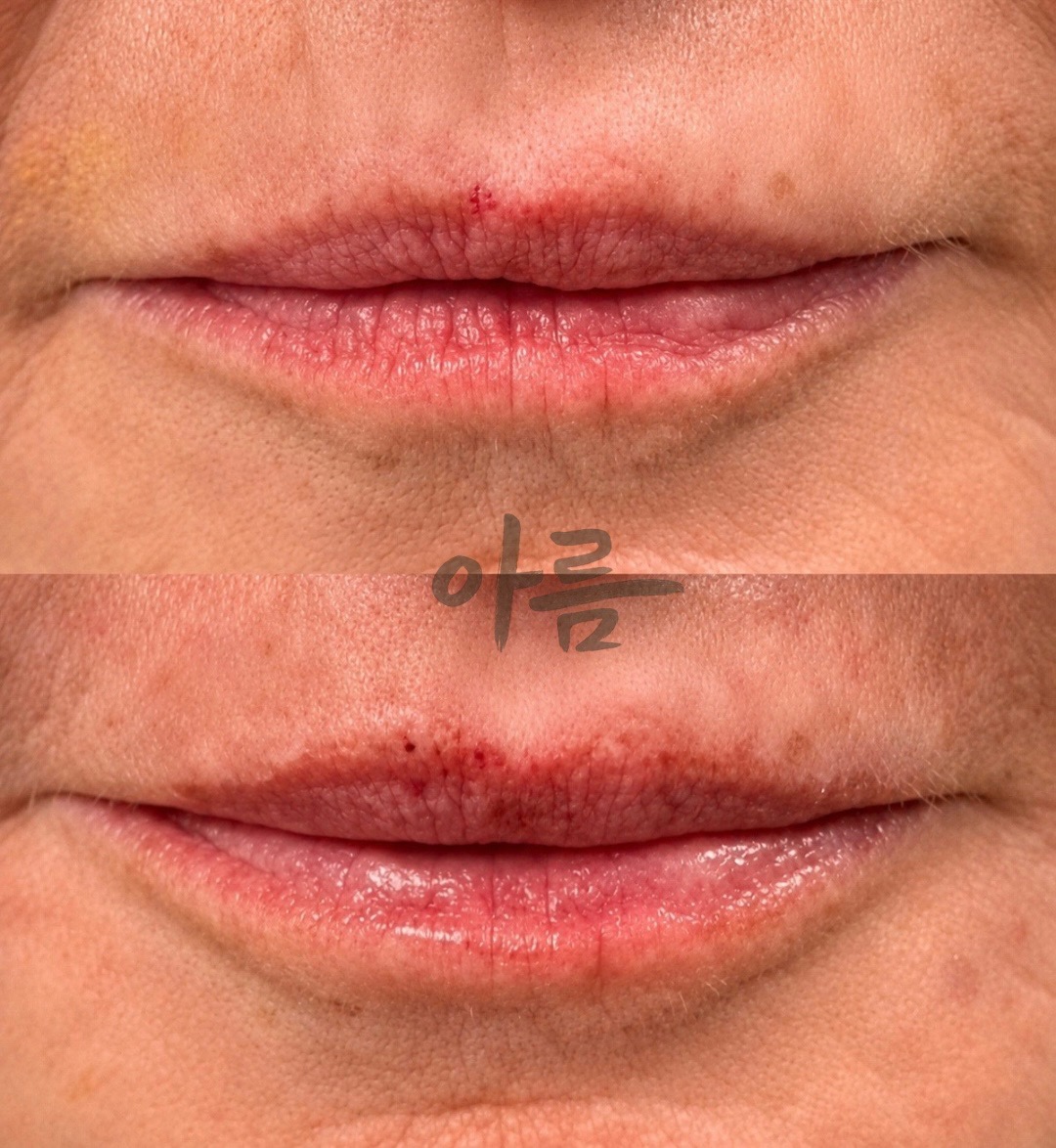 Before-and-after Evolysse filler comparison showing the lips from the front