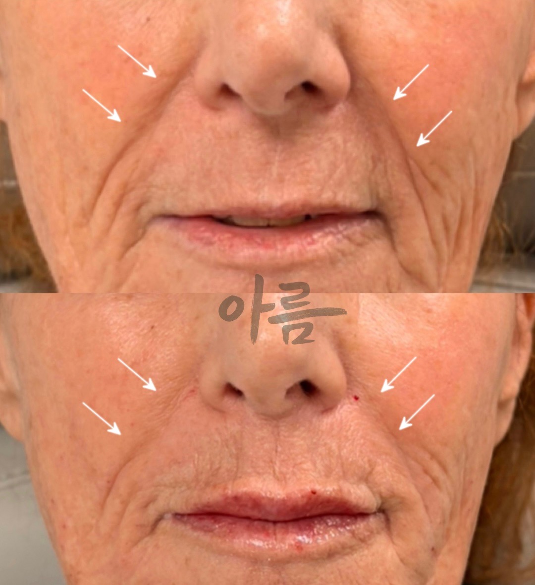 Before-and-after Evolysse filler comparison showing smile lines around the mouth
