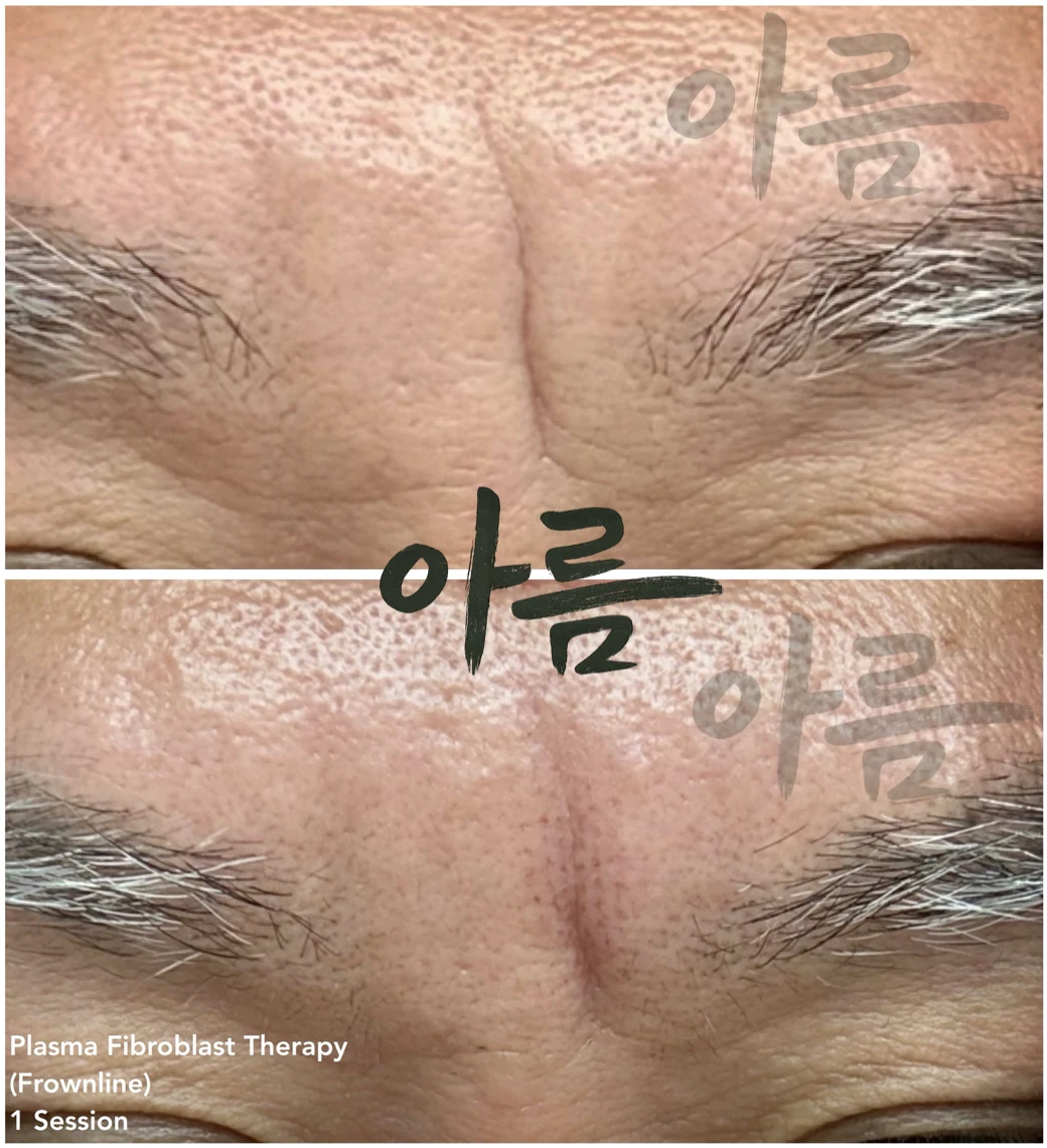 Treatment comparison photograph 1 from the Areum Haus gallery