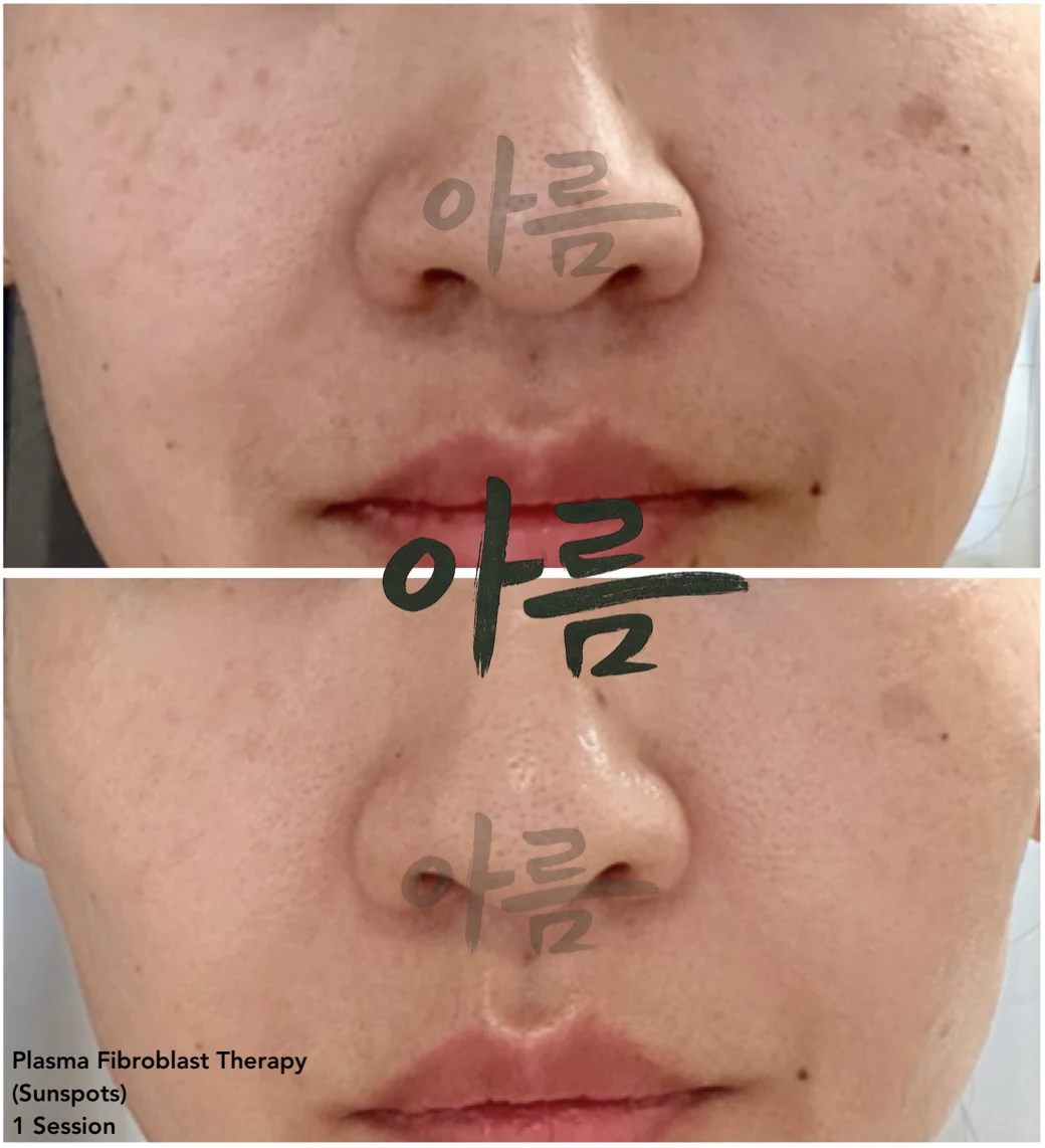 Treatment comparison photograph 2 from the Areum Haus gallery