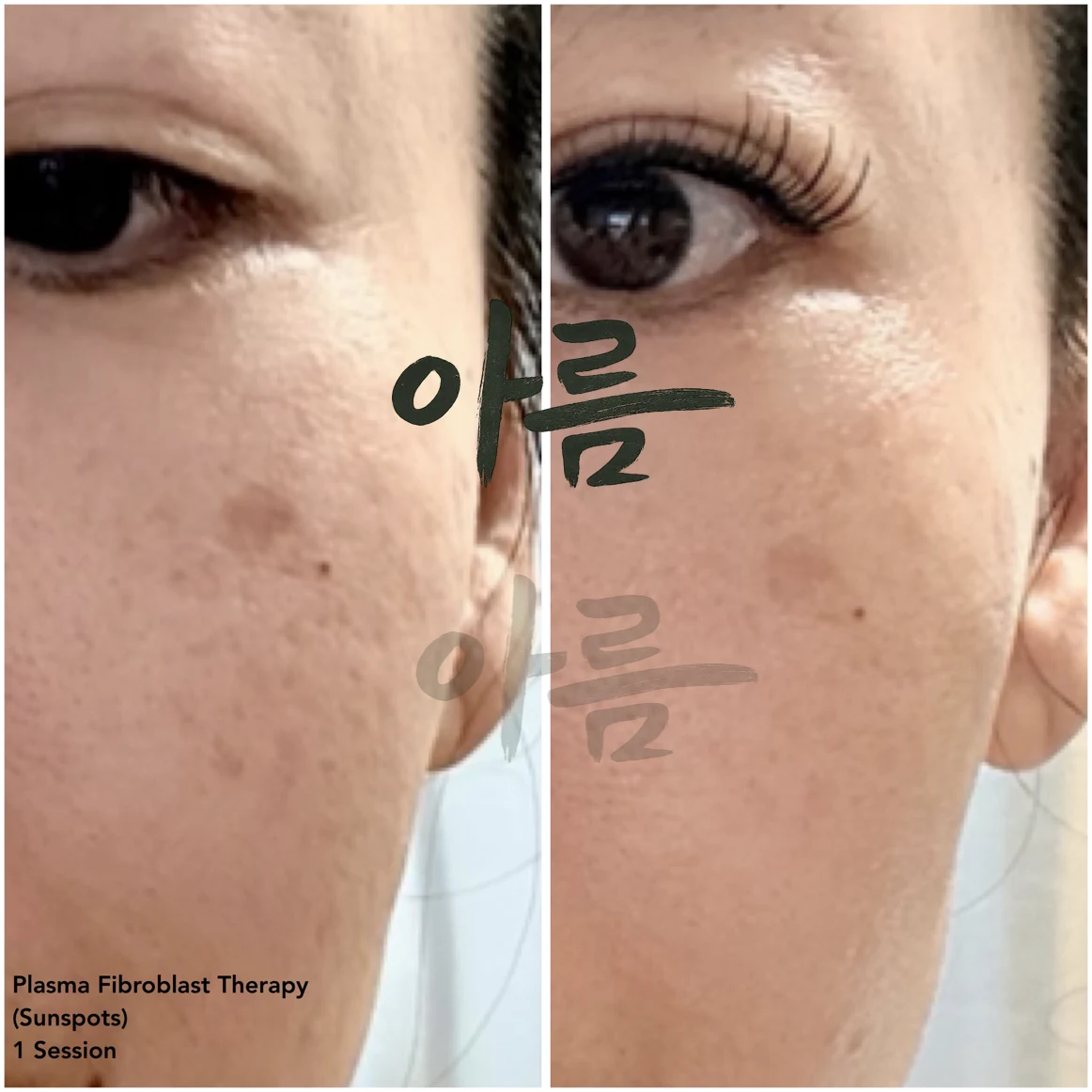 Treatment comparison photograph 3 from the Areum Haus gallery