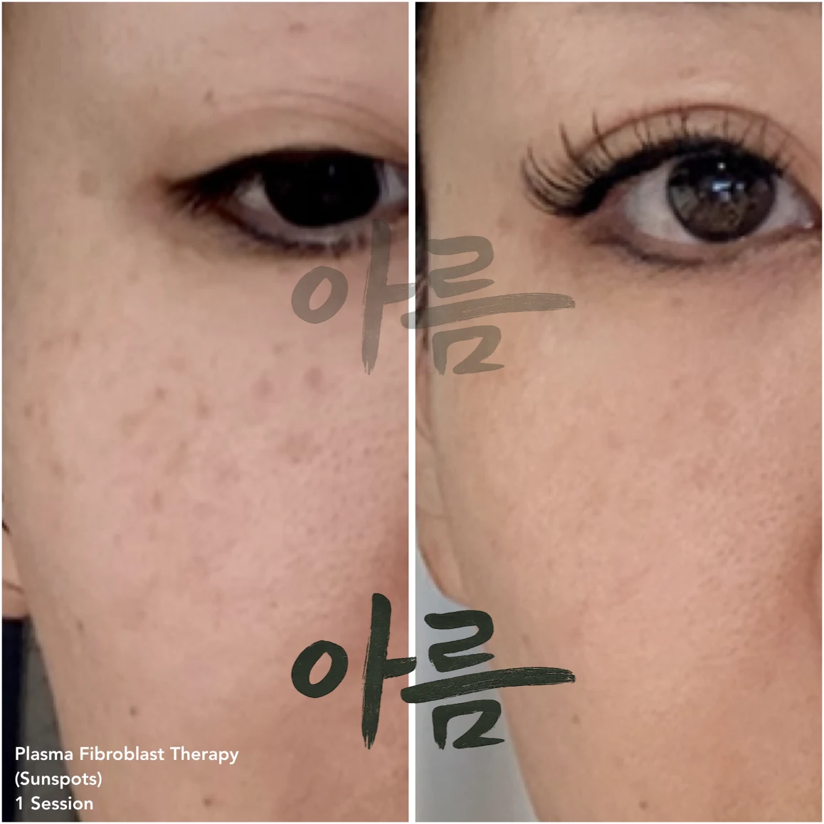 Treatment comparison photograph 4 from the Areum Haus gallery
