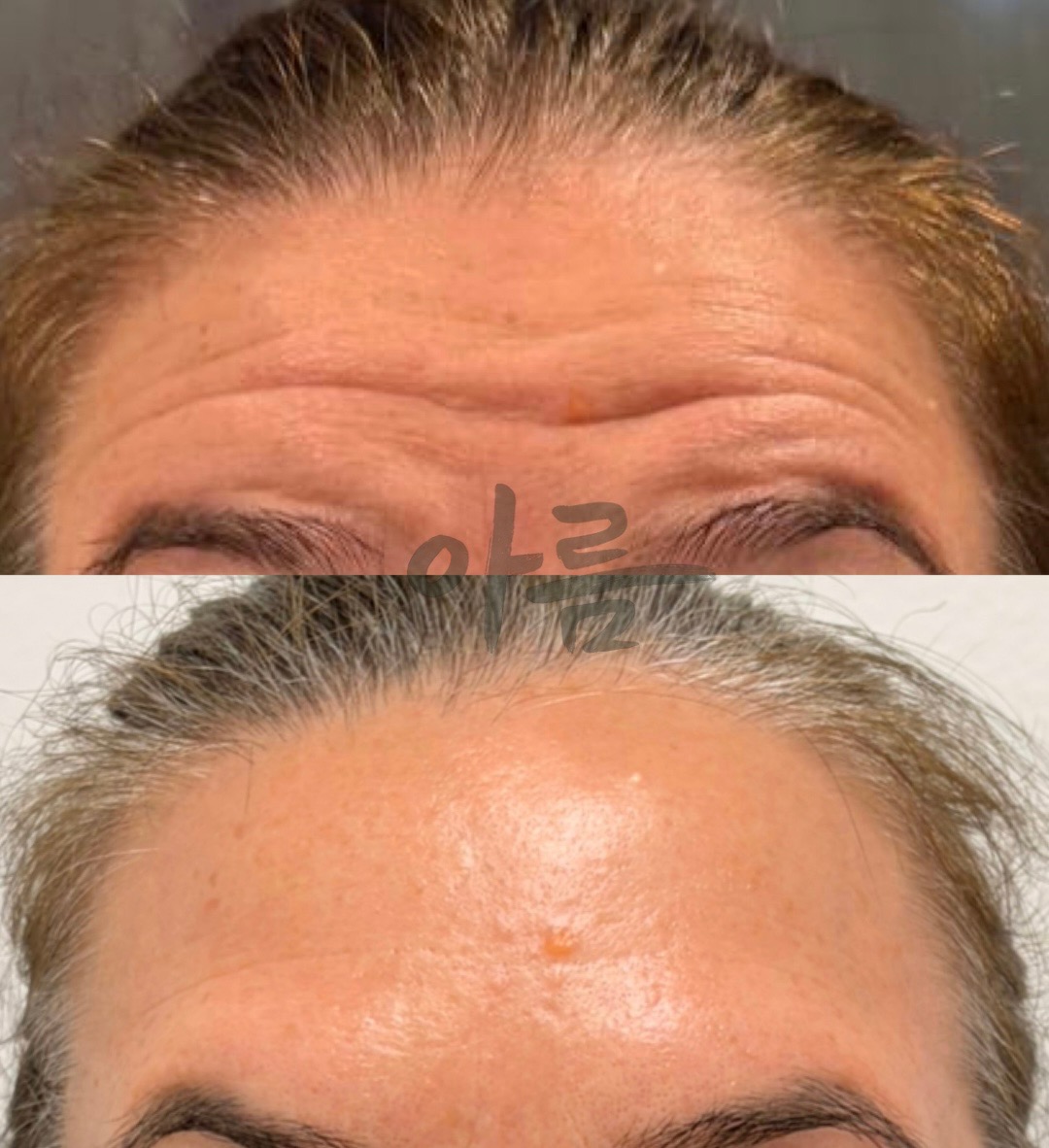 Jeuveau treatment comparison showing the forehead