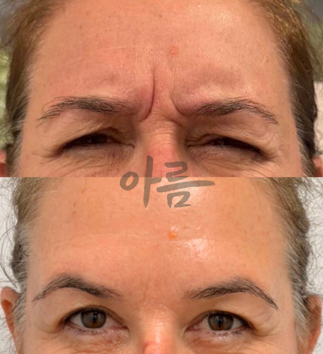 Jeuveau treatment comparison showing frown lines between the eyebrows