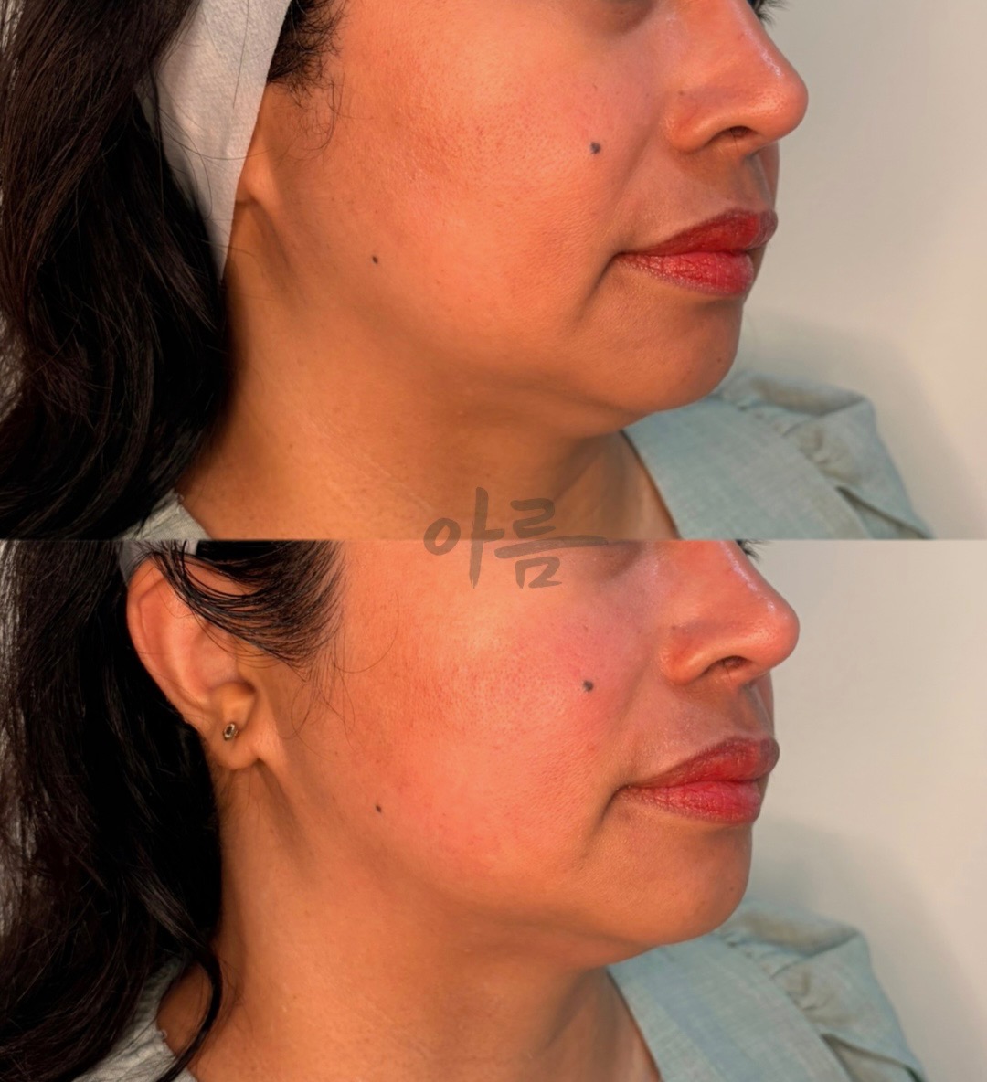 XERF before-and-after comparison of the lower face and jawline after one session