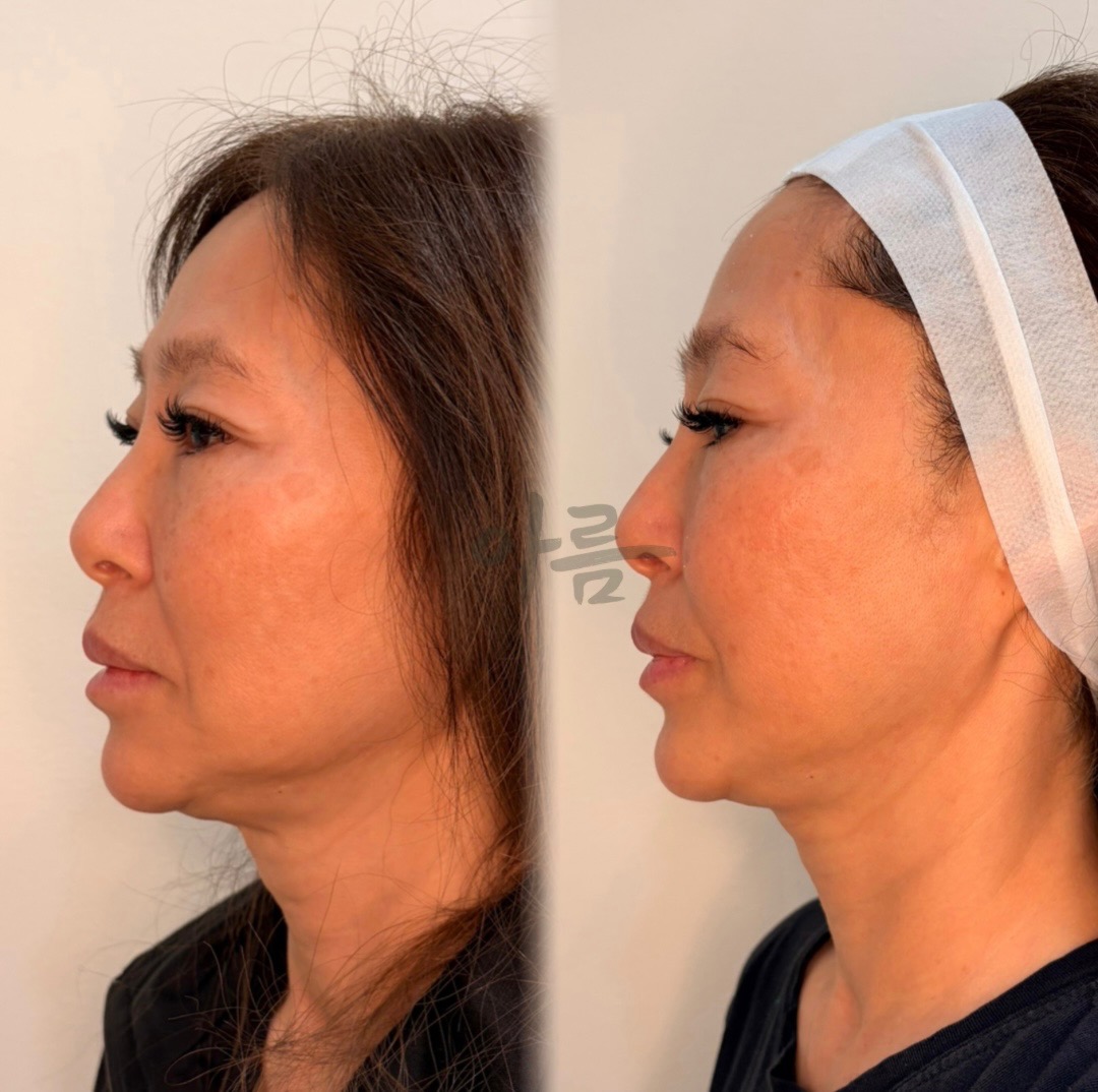XERF before-and-after profile comparison after one session