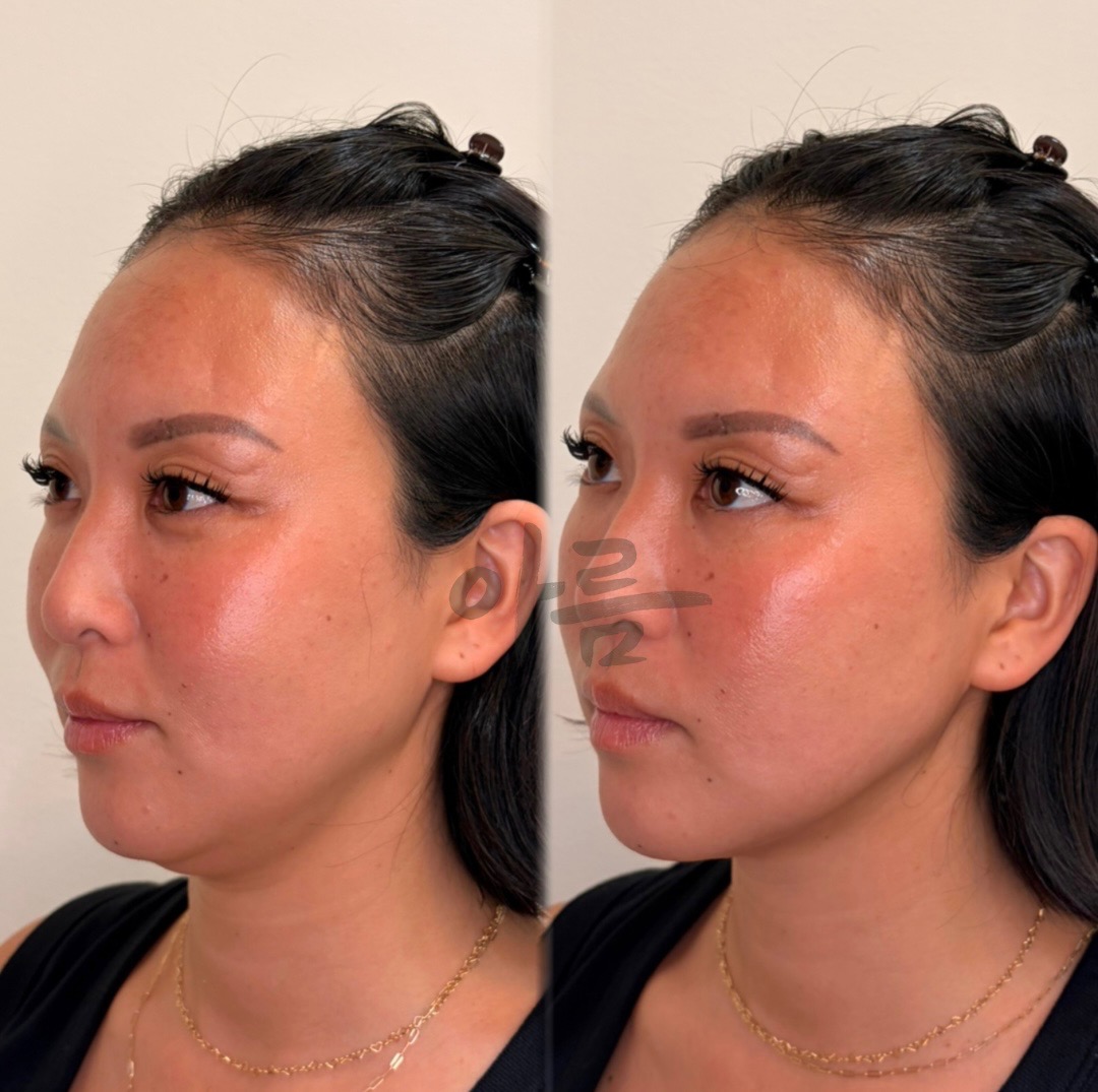 XERF before-and-after three-quarter facial comparison after one session